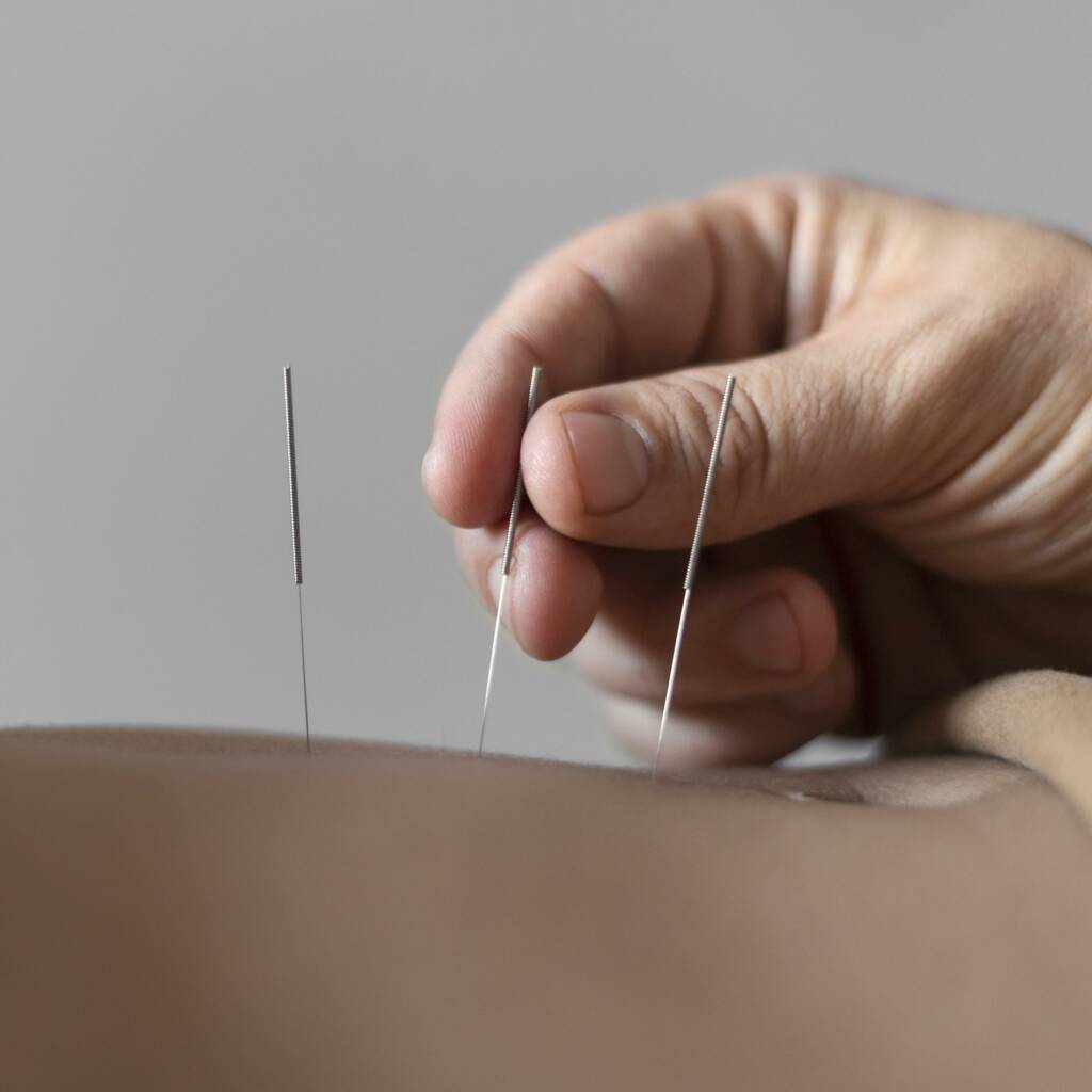 Sam Bowen ND Acupuncture